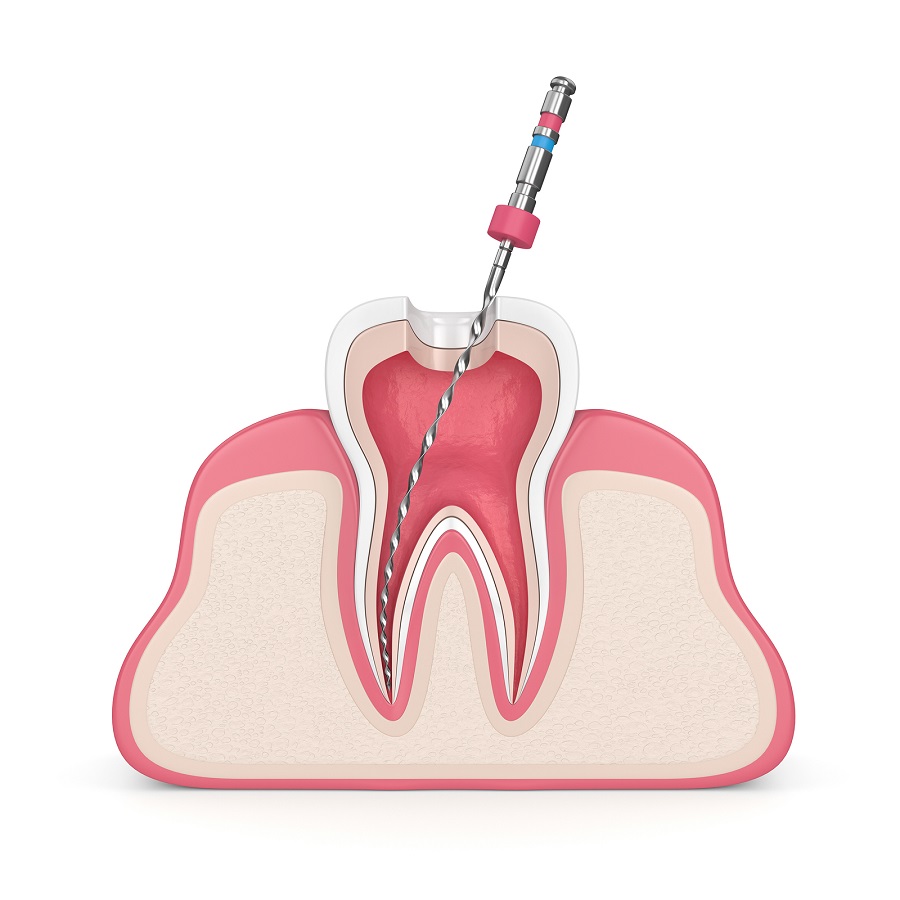 Do You Have a Root Canal Infection?