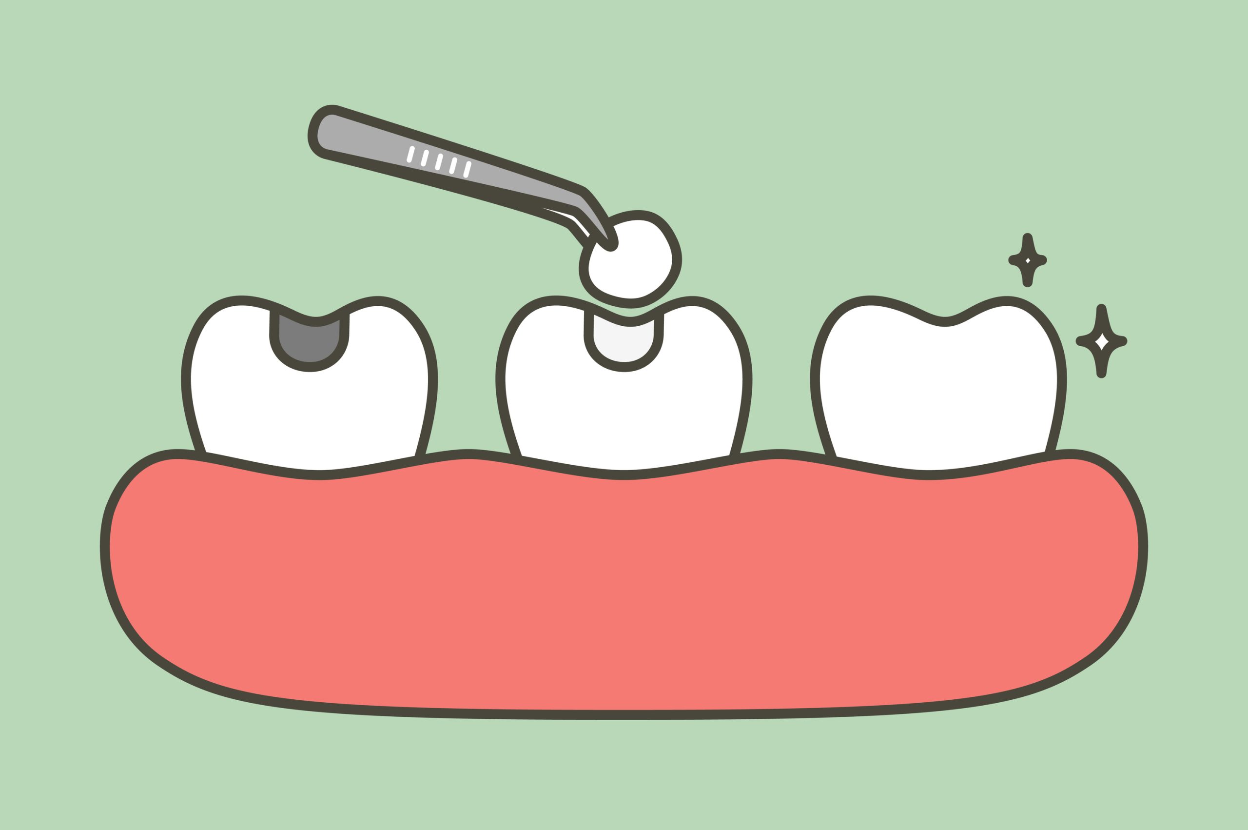 The Benefits of Cosmetic Fillings